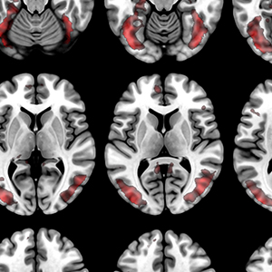 多张带有红色高光的黑白大脑扫描图。